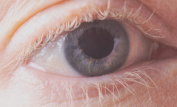 Macro-eye damage (glaucoma)